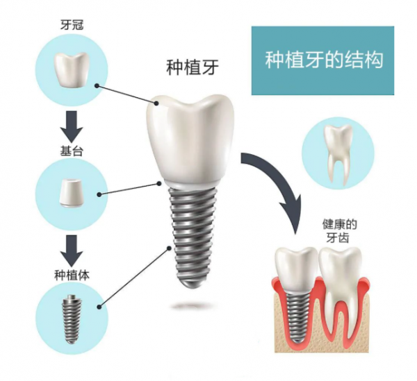 种植牙