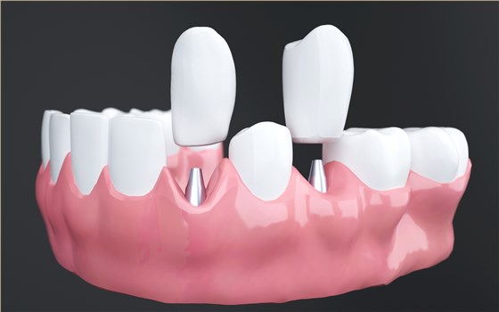 摄图网_401802867_牙齿整形（非企业商用）